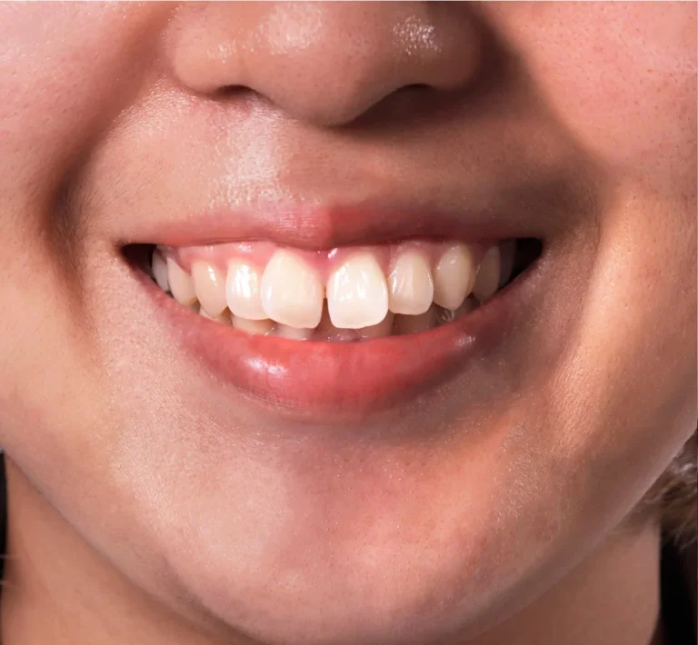 Braces & Clear Aligners 1 before