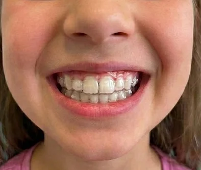 Braces & Clear Aligners 2 after