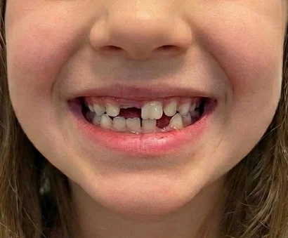 Braces & Clear Aligners 2 before