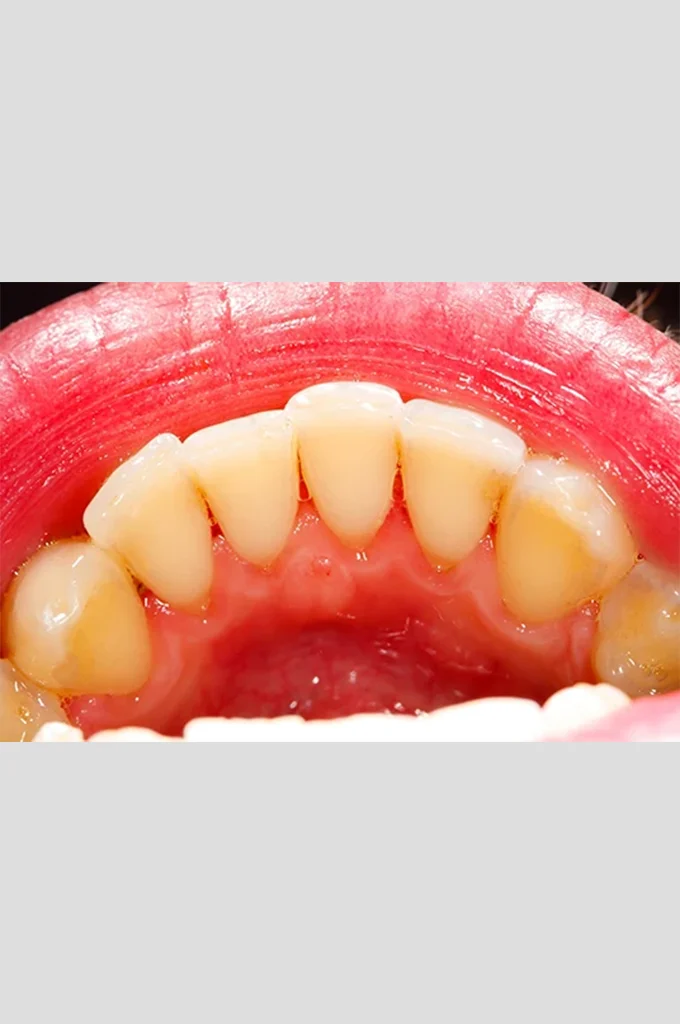 Dental Cleaning after 1