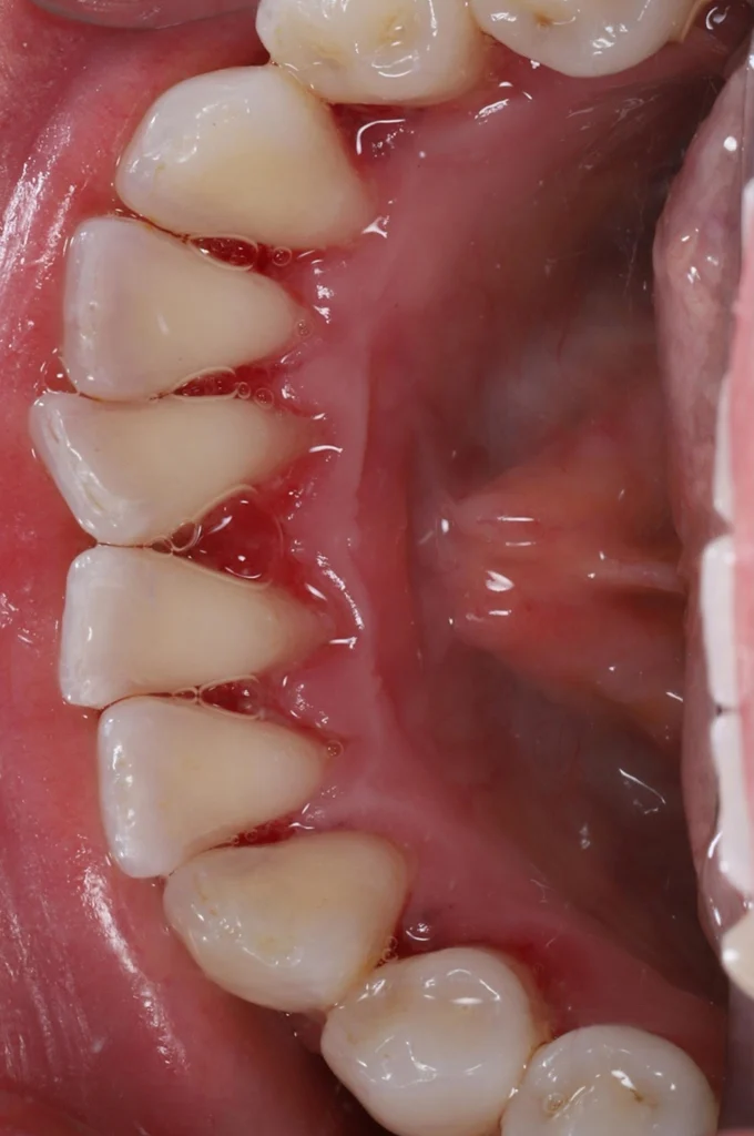 Dental Cleaning after 2