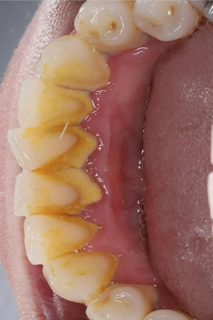 Dental Cleaning after 2