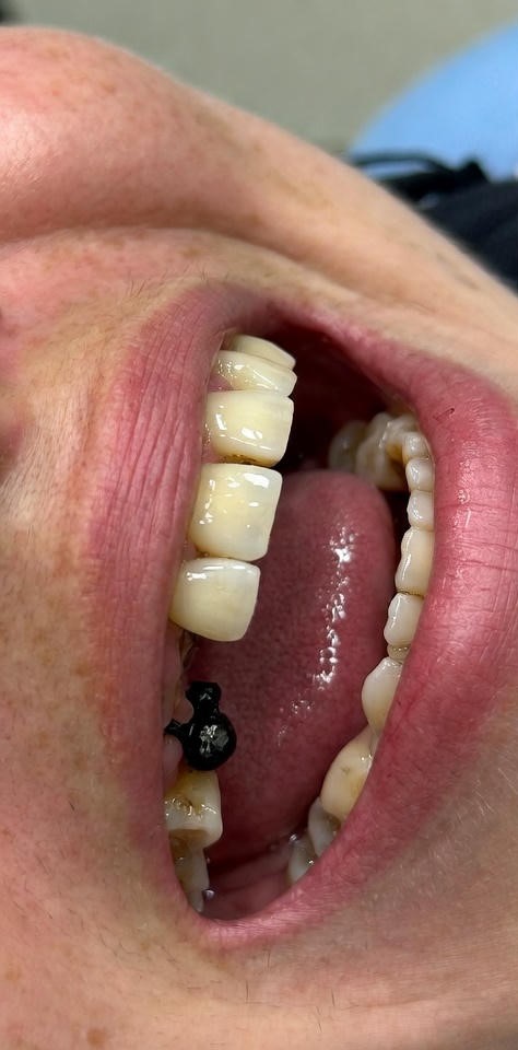 Dental_Implants_11