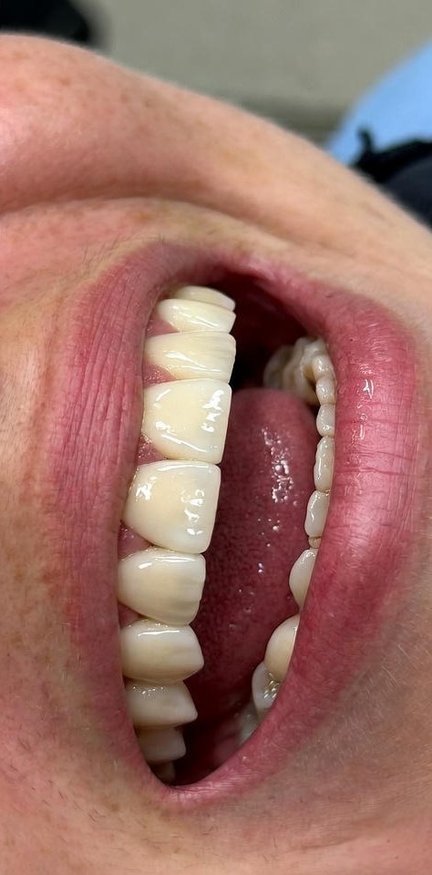 Dental_Implants_12