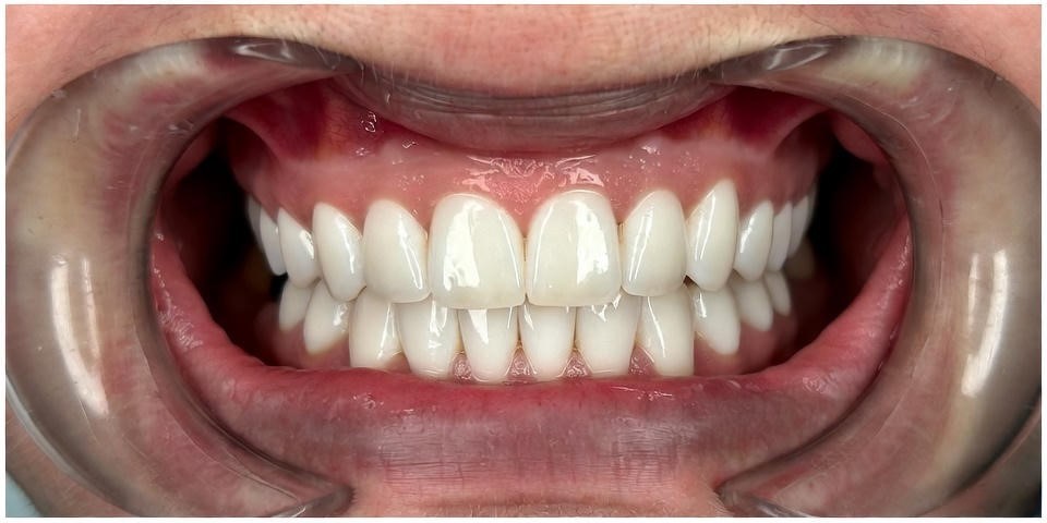 Dental_Implants_22