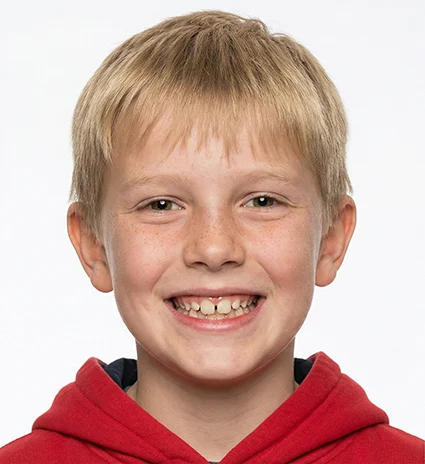 Early Interceptive Orthodontics 1 before