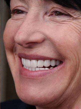 Straight and bright porcelain veneers result in La Habra office