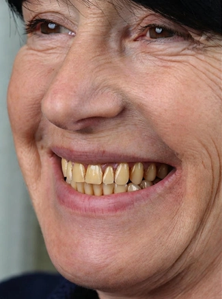 Close-up of crooked and stained teeth before Hollywood Smile makeover
