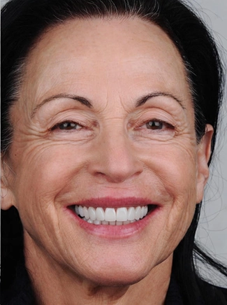 Goald Coast Dental hollywood-smile-2-after
