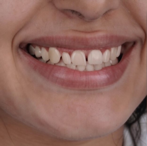 Invisalign21
