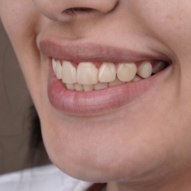 Invisalign22