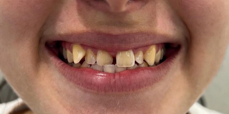 Invisalign_clear_aligners1