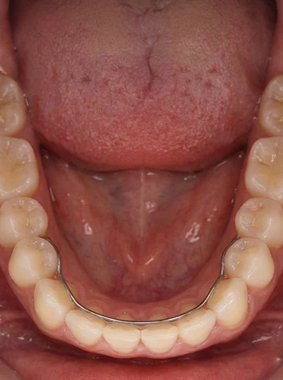 Orthodontic Retainers 1 after