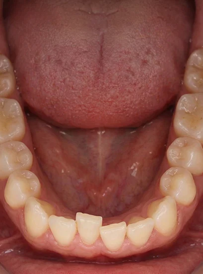 Orthodontic Retainers 1 before