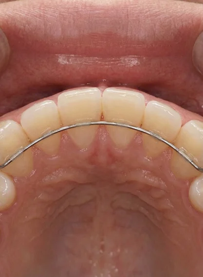 Orthodontic Retainers 2 after