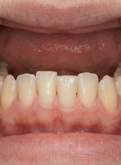 Orthodontic Retainers 2 before