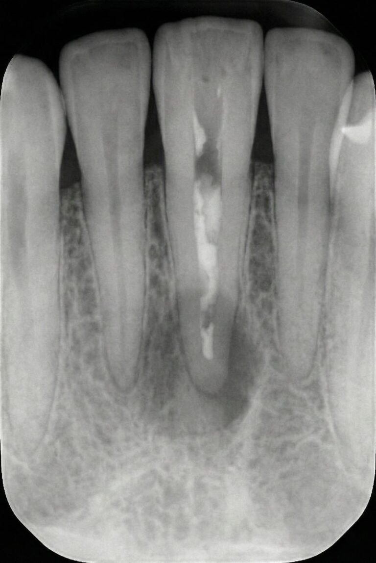 Retreatment Root Canal11