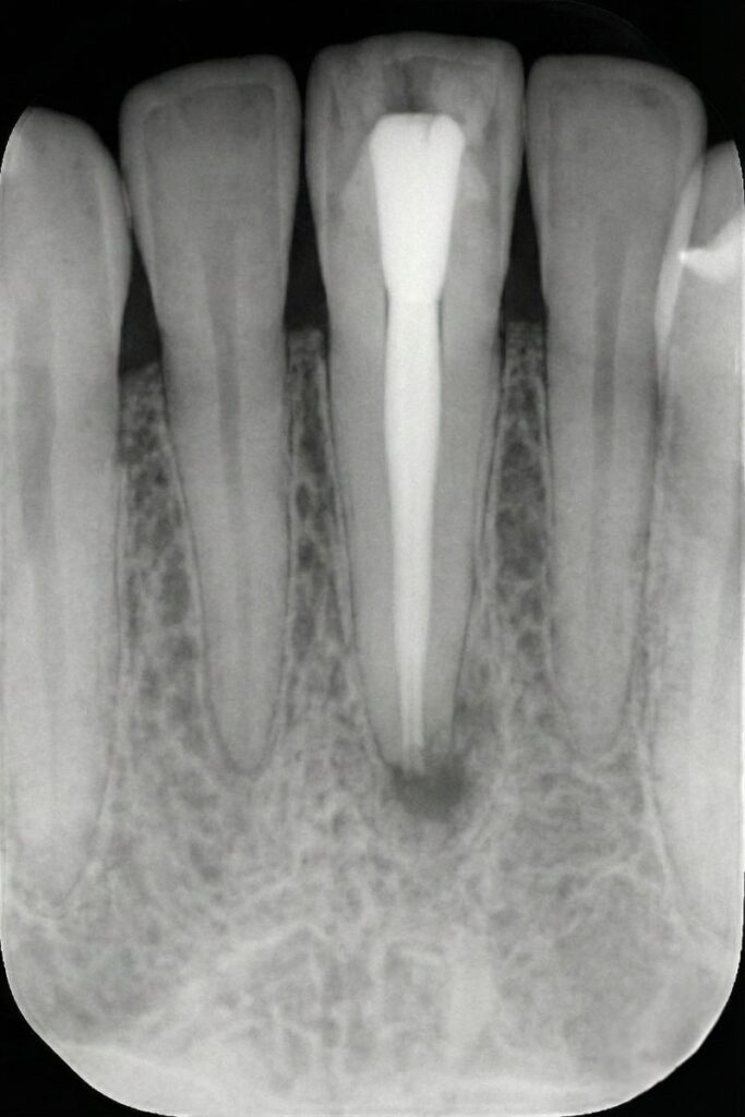 Retreatment Root Canal12