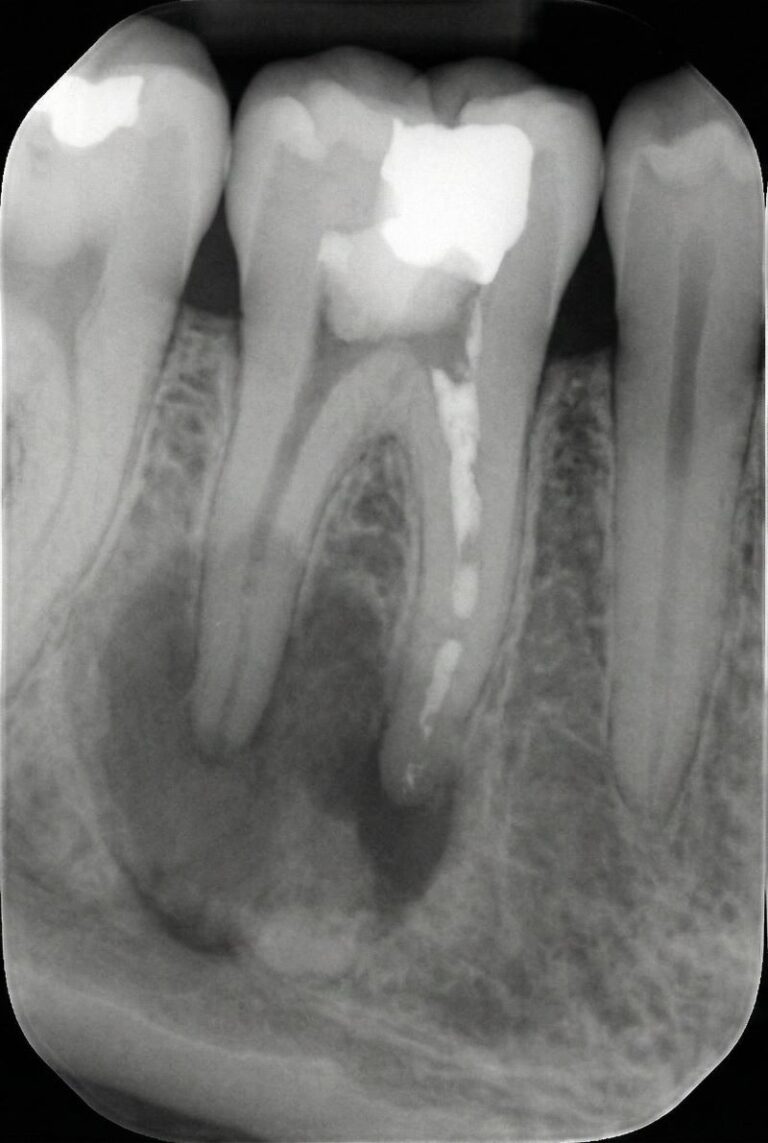 Retreatment Root Canal21