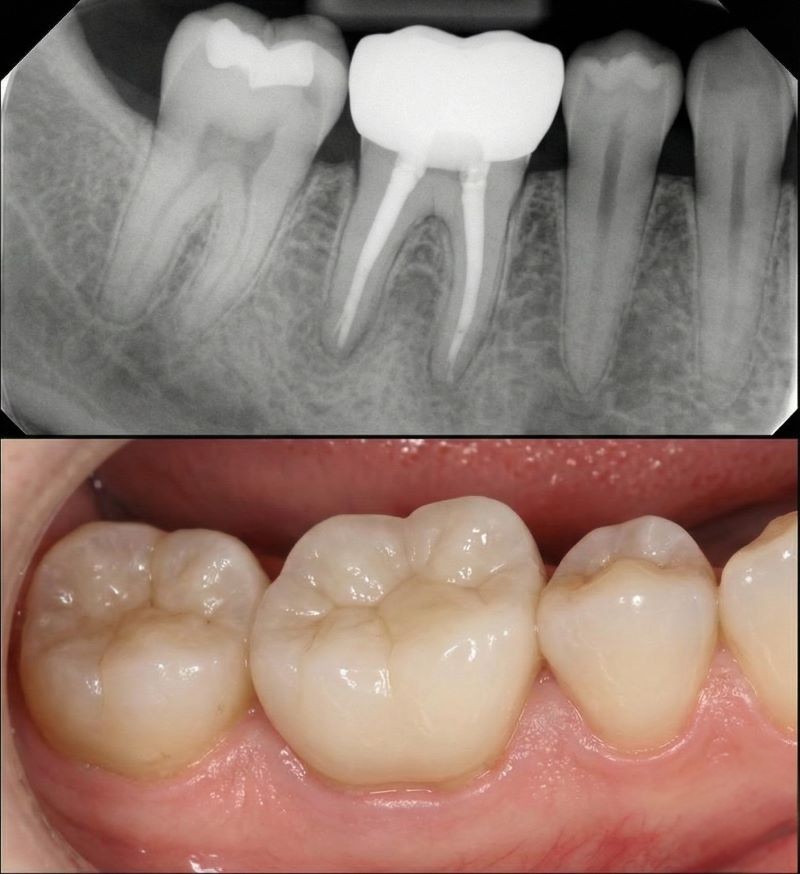 Root Canal Therapy12