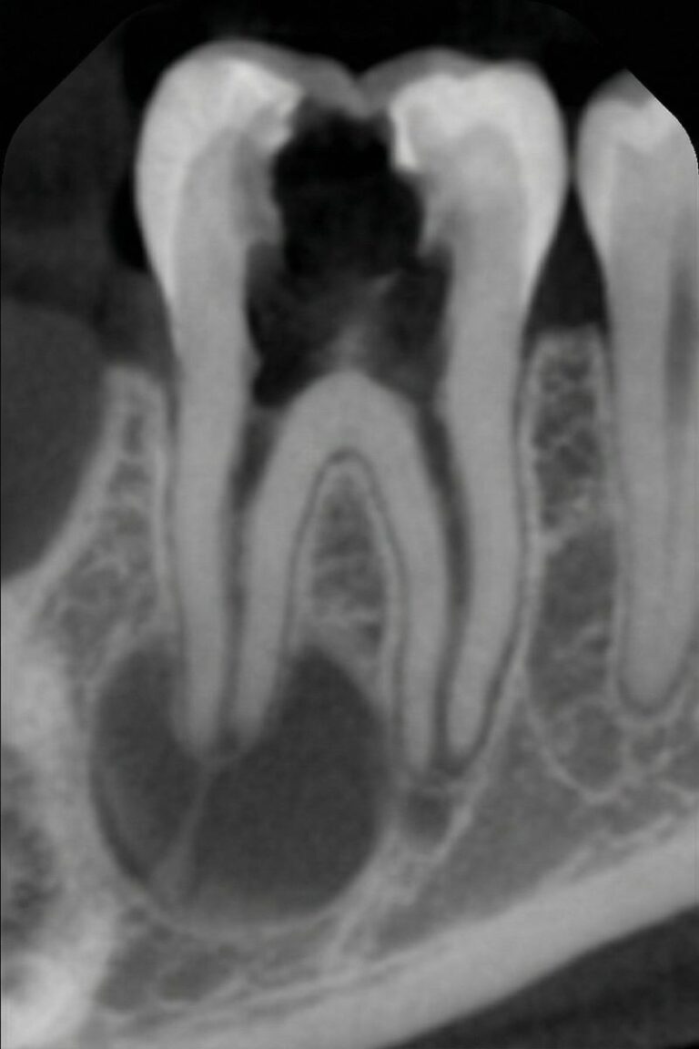 Root Canal Therapy21