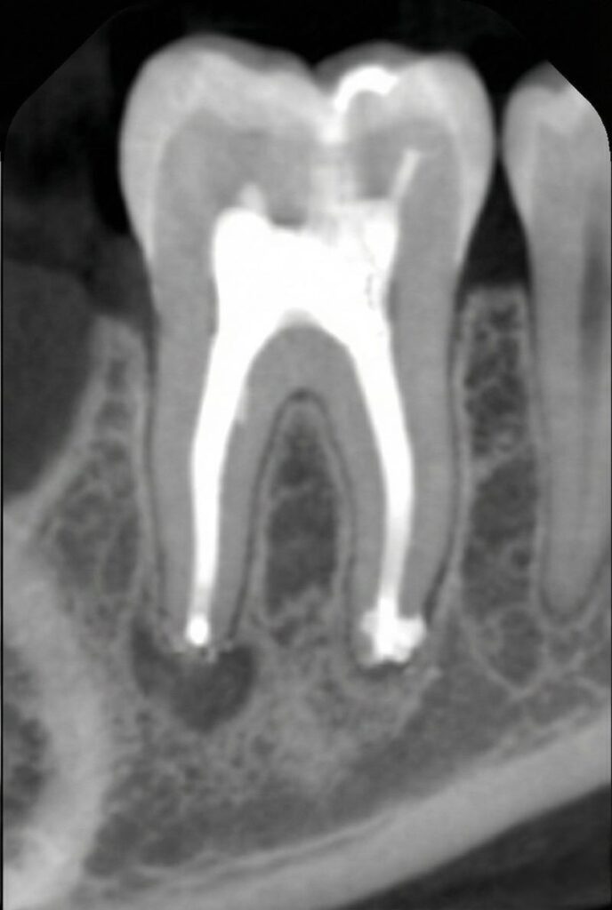 Root Canal Therapy22
