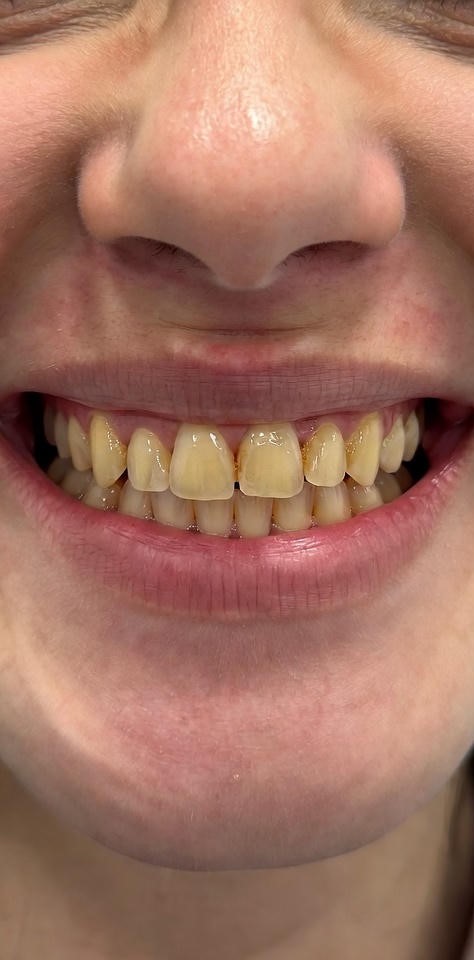 Teeth_Whitening_011