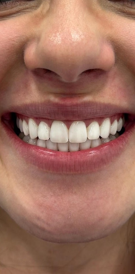Teeth_Whitening_012
