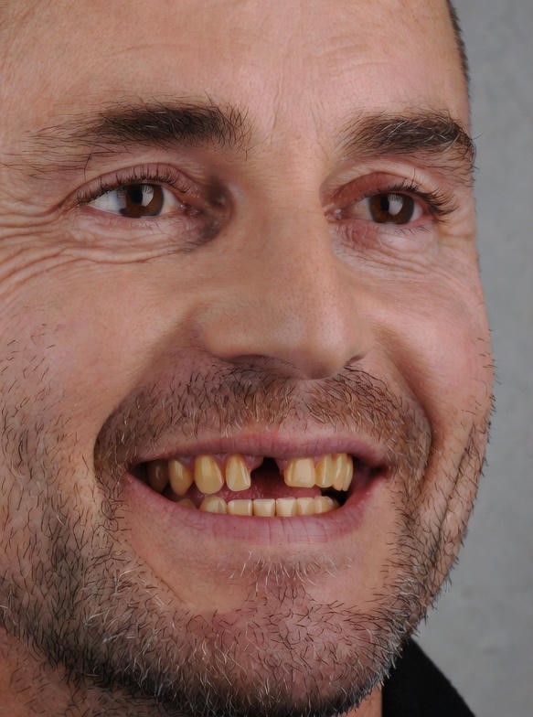 composite_veneers_011