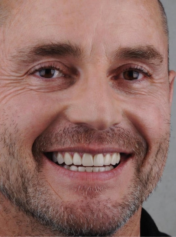 composite_veneers_012