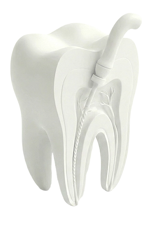 Post-treatment care for root canal therapy Gold Coast Dental