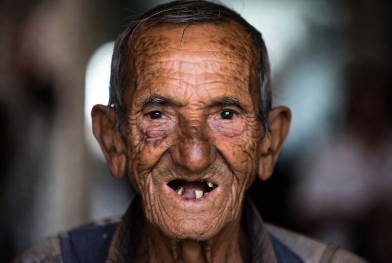 full-mouth-rehabilitation_01