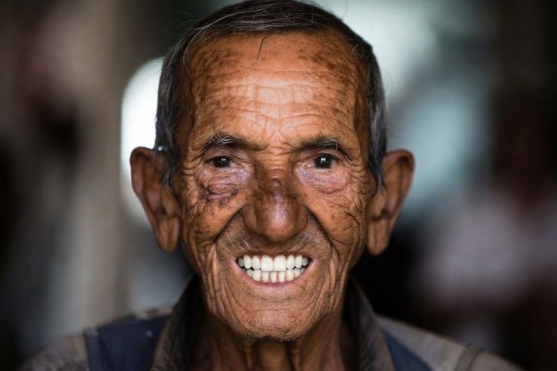 full-mouth-rehabilitation_02