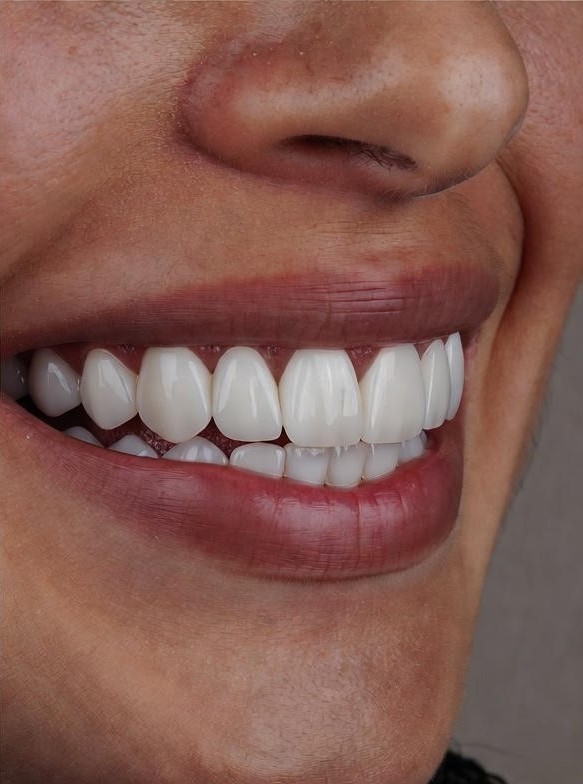 porcelain-veneers12