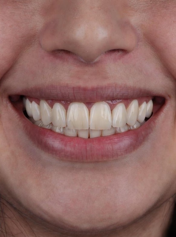 porcelain-veneers22