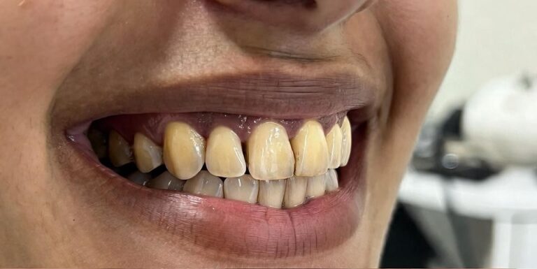 veneers_11