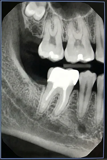 Dental-Filling-01 after