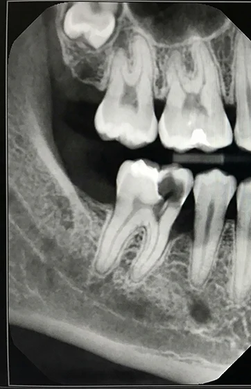Dental-Filling-01 befire