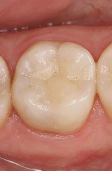 Dental-Filling (2) after