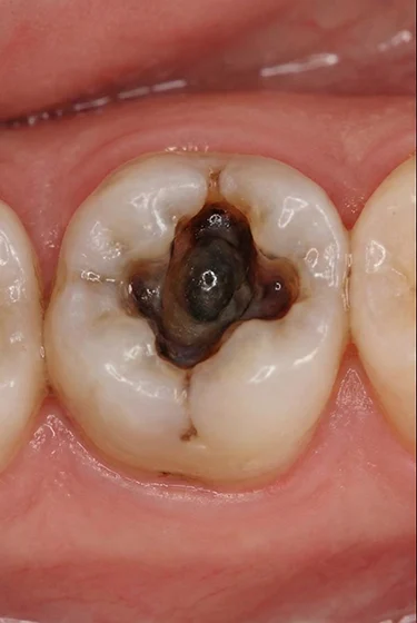 Dental-Filling (2) before