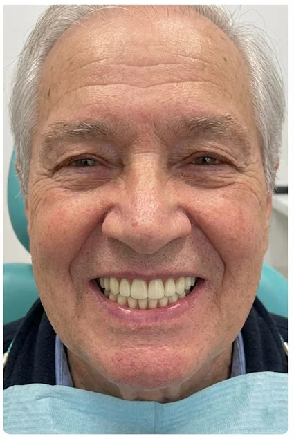 Implant Supported Denture 2 - after