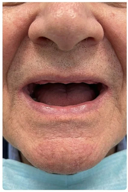 Implant Supported Denture 2 before