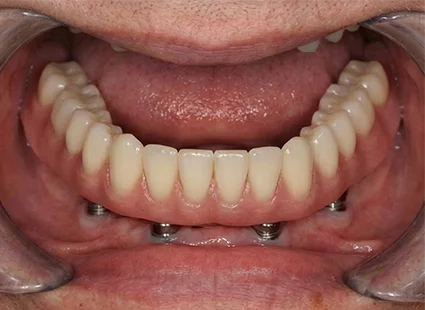 Implant-Supported Denture after