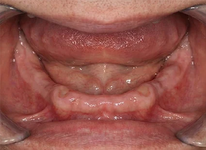 Implant-Supported Denture before