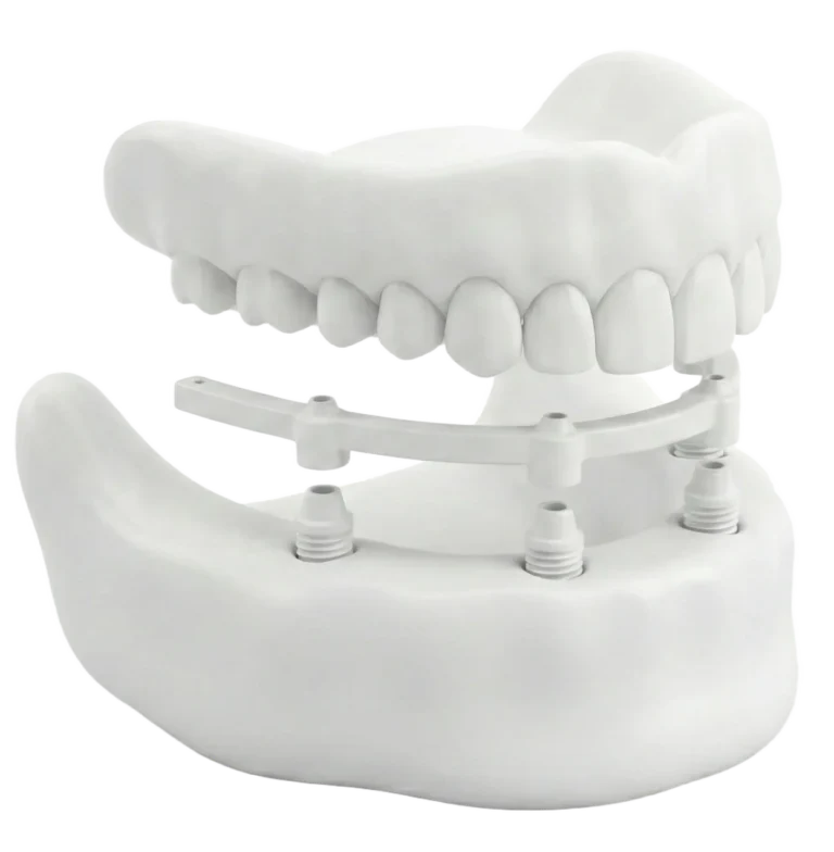 Implant‑Supported Dentures