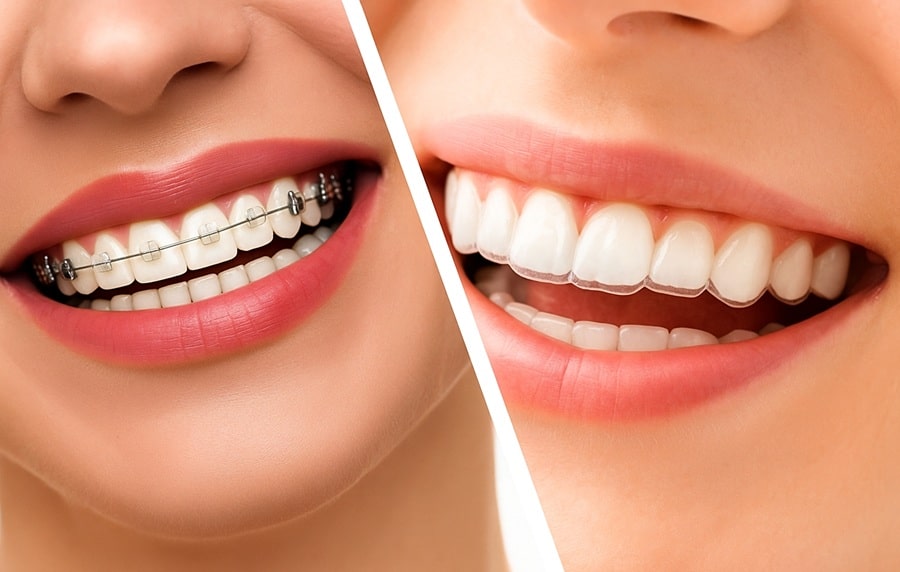 Invisalign_Cost_Procedure_Time