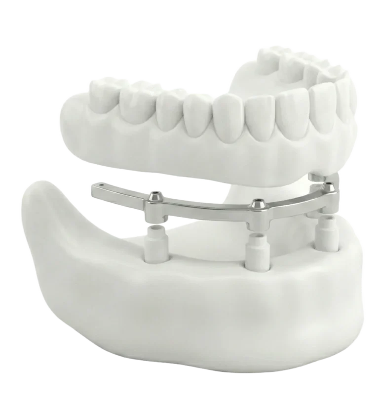 All‑on‑4 Dental Implants