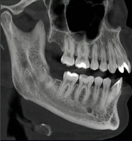 extractions-wisdom-teeth-Gold-coast-dental after