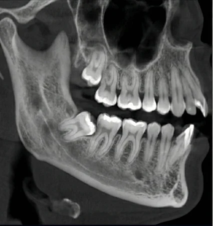 extractions-wisdom-teeth-Gold-coast-dental before