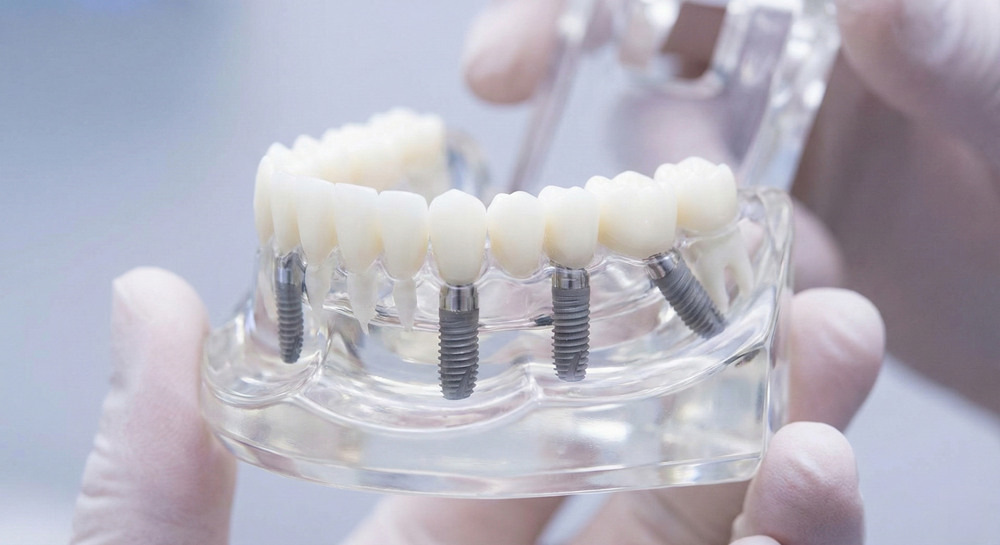 all-on-x-dental-implants